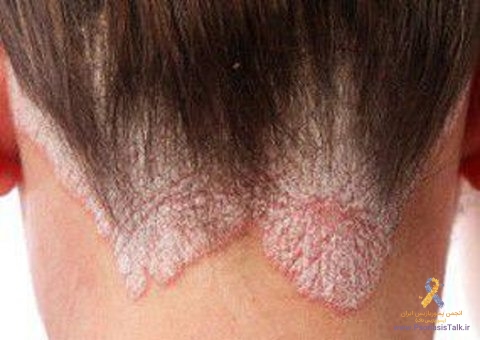 افزایش وزن چه تاثیری بر بروز بیماری پسوریازیس دارد؟