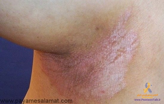 علت، نشانه ها و درمان پسوریازیس معکوس