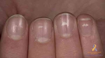 پسوریازیس ناخن