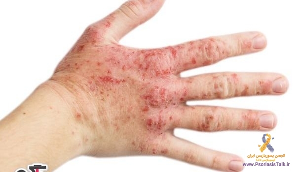 اگزمای پوستی چیست و چه کسانی را مبتلا میکند