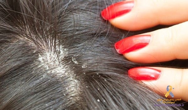 خارش ، سوزش و شوره ی سر