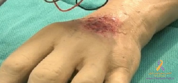 ابزارهای پزشکی ساخت ایران به کمک ضایعه های پوستی آمده است