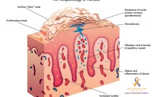 پسوریازیس چیست