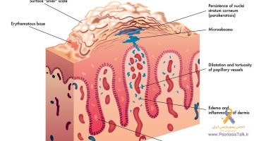 پسوریازیس چیست
