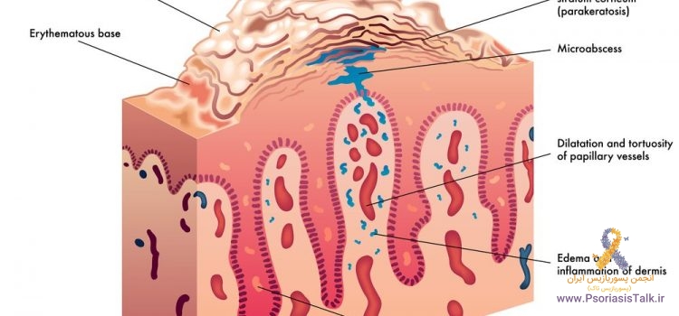 پسوریازیس چیست پسوریازیس چیست