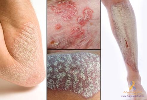 شروع طرح تحقیقاتی با هدف بررسی تاثیر سلول های بنیادی در درمان پسوریازیس در پژوهشگاه رویان