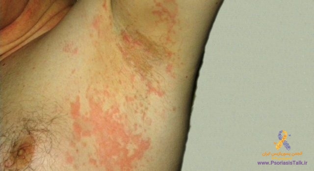 خارش زیر بغل و خلاص شدن از پسوریازیس این ناحیه