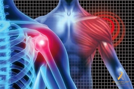 احتمال درگیری مفصلی برای مبتلایان به بیماری پوستی پسوریازیس